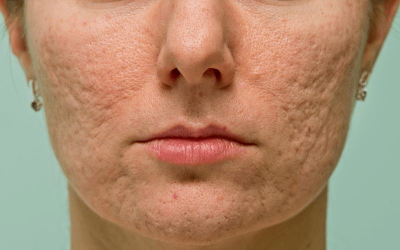 Correção de cicatrizes de acne - Persona Dermatologia - Melhor Clínica de  dermatologia de Natal - RN